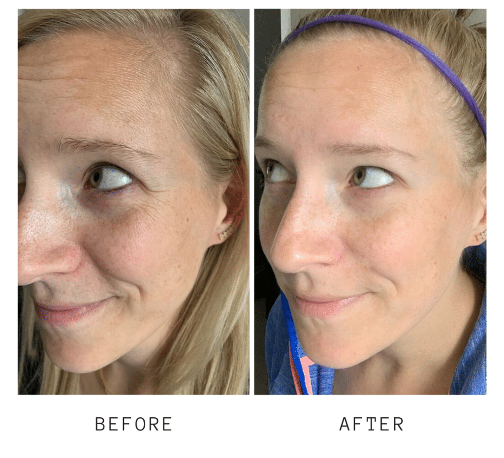 Overnight Resurfacing Peel before and after
