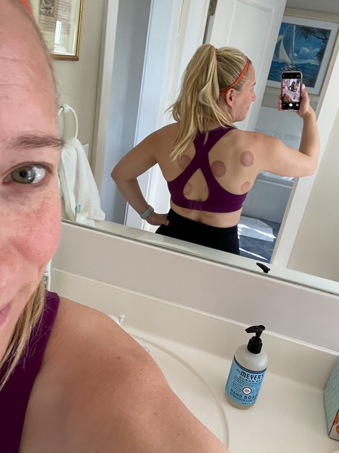 cupping marks | Shore Is Beautiful